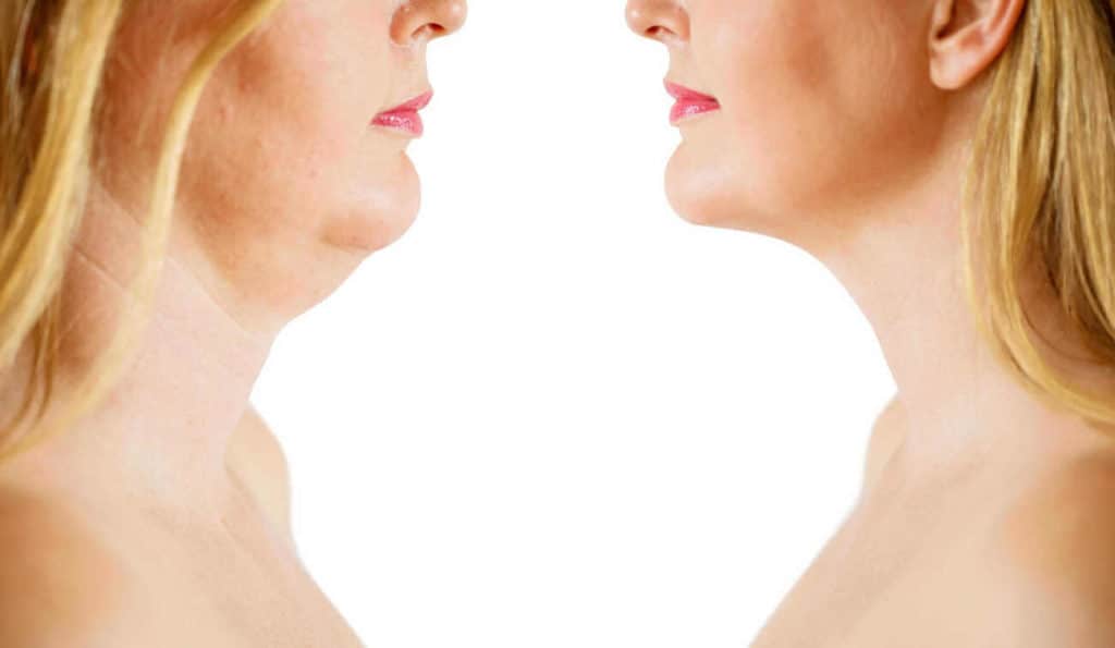 Double Chin treatment Leicester before and after results