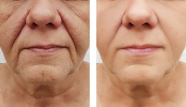 Learn more about Morpheus8 Treatment Leicester today!