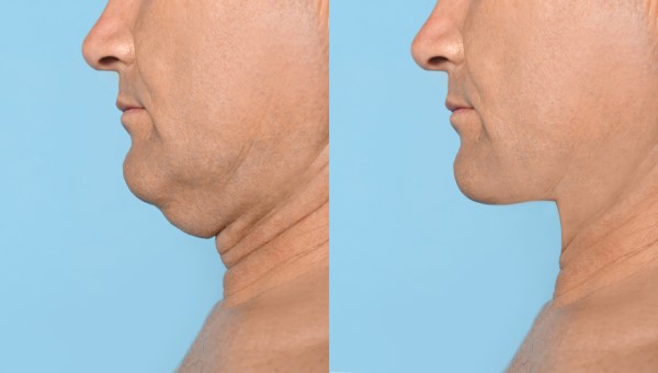 Which Non-Surgical Treatments Work Best for Jowls and Loose Skin Leicester?