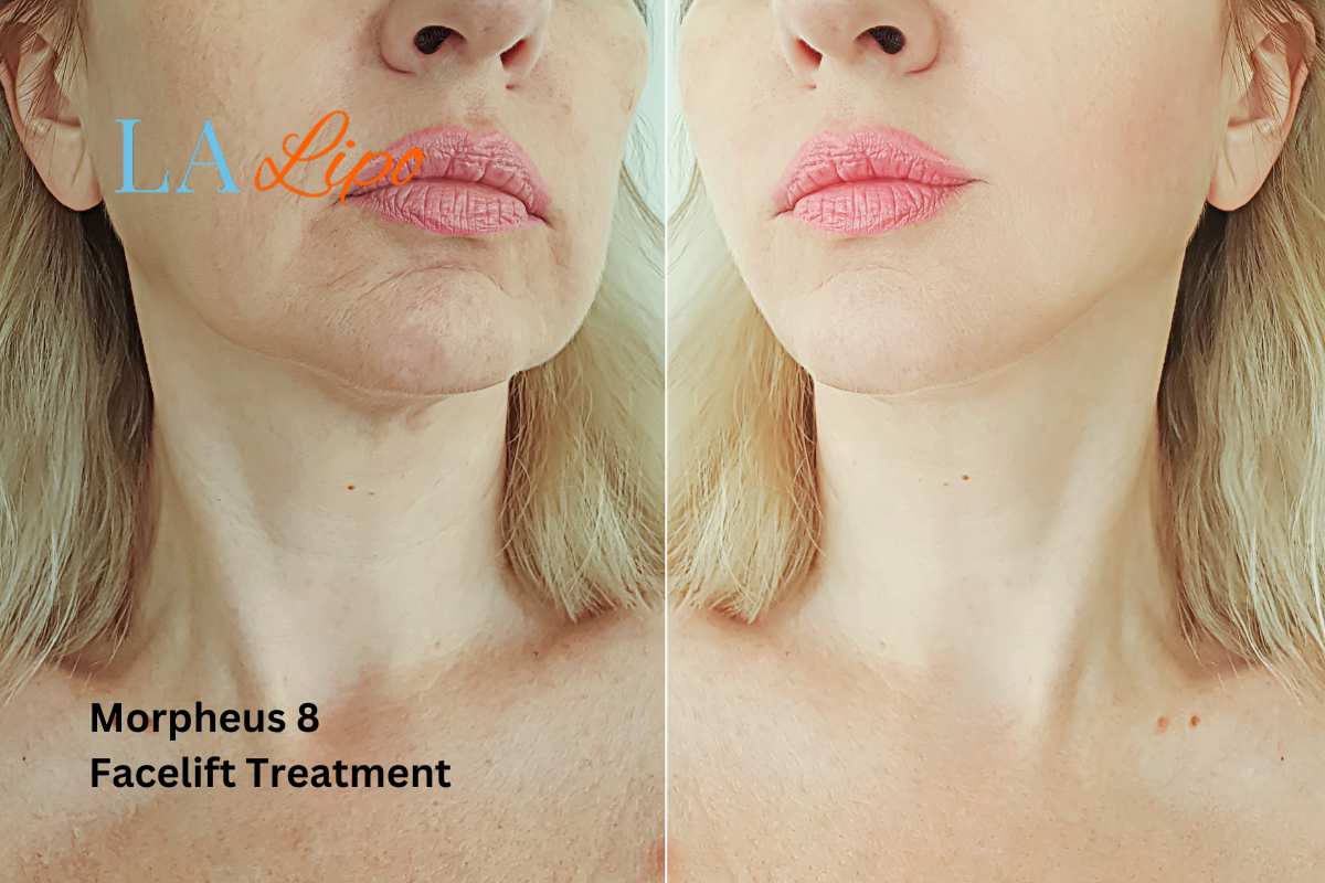 Turn back time with Morpheus8 Treatment Leicester