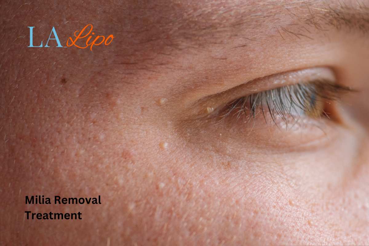 Cryopen Milia Removal: Is It the Easiest and Safest Option Leicester?