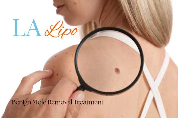 Woman having her inspection of blemish before mole removal Leicester