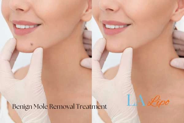 Before and after mole removal Leicester treatment