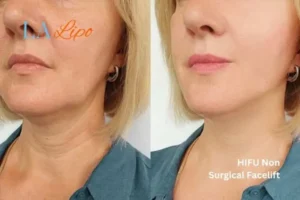 hi-fu for wrinkles Leicester before and after results