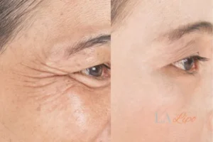 Before and after results of woman - HI-fu wrinkles reduction treatment Leicester