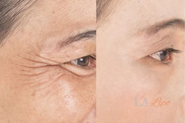 Before and after results of woman - HI-fu wrinkles reduction treatment Leicester