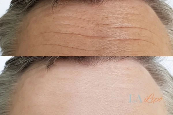 results of HIFU Leicester on mans forehead to help reduce lines and wrinkles