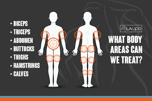 Graphic to show areas you can have LA-EMS Body Sculpting Leicester treatment.
