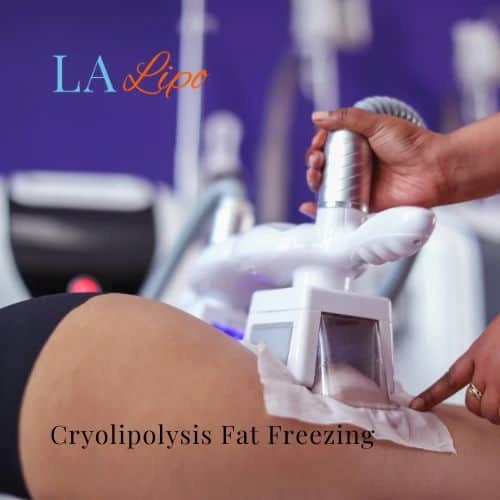 fat freezing - Cryolipolysis Leicester