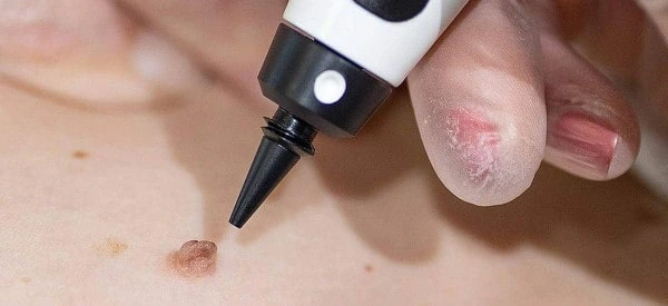 skin tag removal using cryopen Leicester