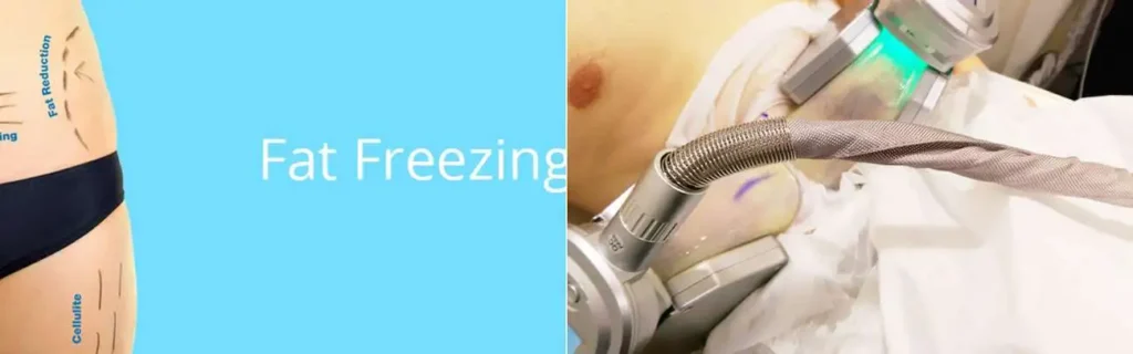 multi areas of a persons body having coolsculpting Leicester treatment