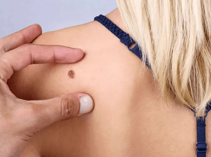 woman having mole removal Leicester consultation before treatment.