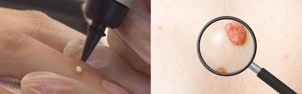 Person getting moles removed with cryopen Leicester