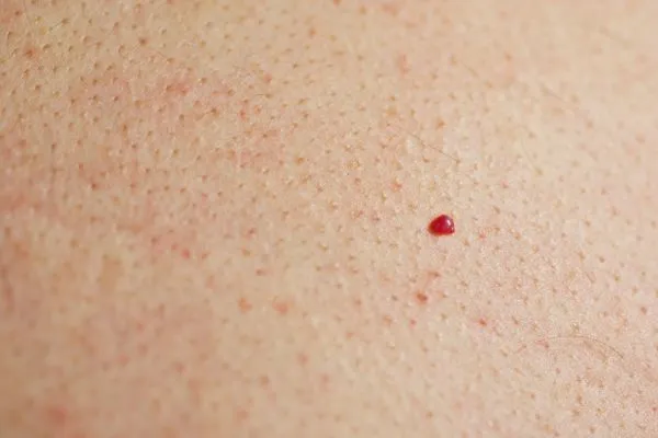 close up of a cherry angioma Leicester