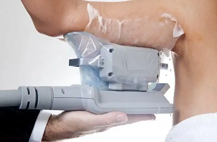 Picture of fat freezing Leicester on the upper arms.
