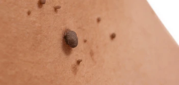 image of a skin tag Leicester