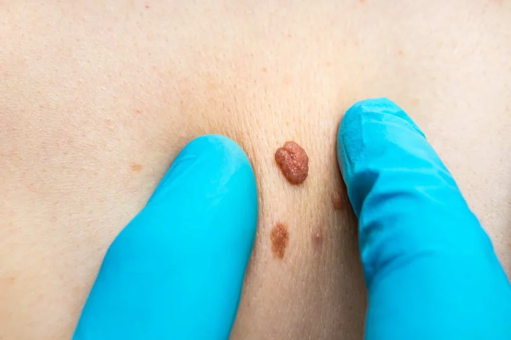 Consultant examining a skin tag Leicester