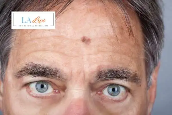 Solar Lentigo Removal Leicester image of man with mark on his forehead