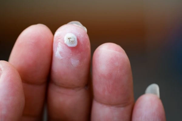 wart on person finger - cryotherapy to treat from LA LIPO Leicester