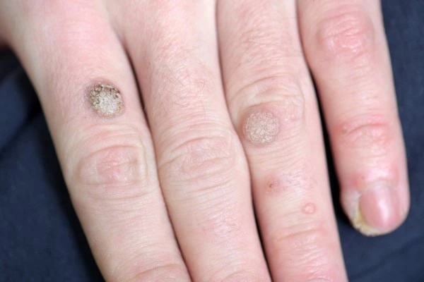 photo of warts on person hand - see wart removal Leicester from LA LIPO