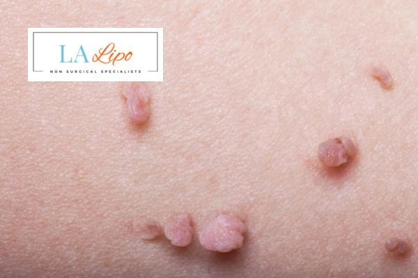 Does cryopen skin tag removal Leicester hurt? Find out now call our team today!