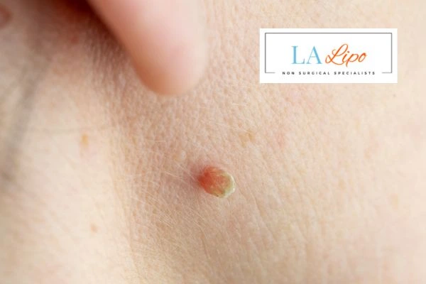 Book skin tag removal Leicester today speak to our team now!