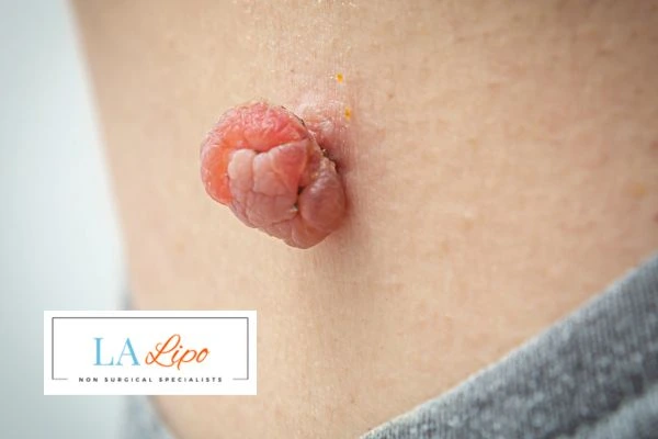 Interested in skin tag removal Leicester? Concerned about the pain? Find out more today!