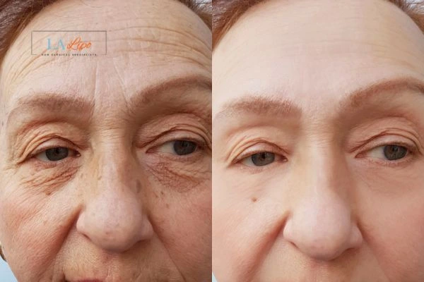 The powerful benefits of Morpheus8 Treatment Leicester - Call Our team today!