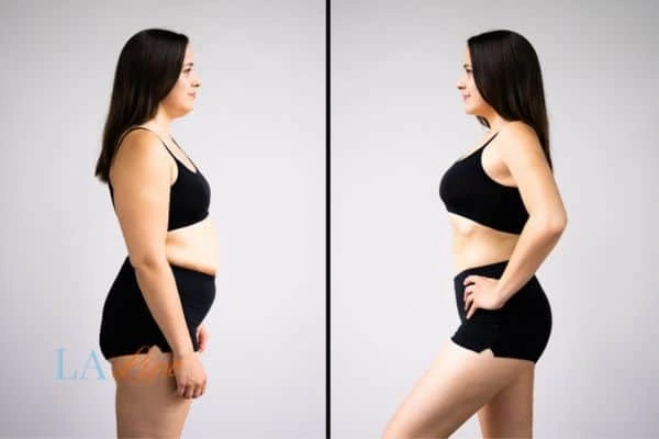 Picture of womans before and after using LA-EMS body sculpting to improve her core strength Leicester