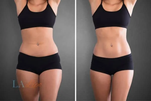 before and after results of non-surgical treatment to help a woman's body image and mental health Leicester