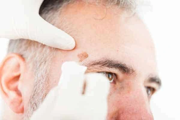 Age spots and elderly people Leicester what is the link?