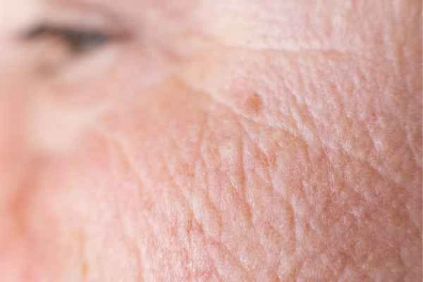 close up picture of a woman's face showing an age spot Leicester