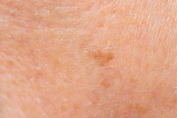 close up picture of age spots Leicester