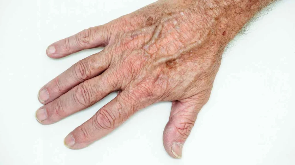 Male hand showing age spot Leicester