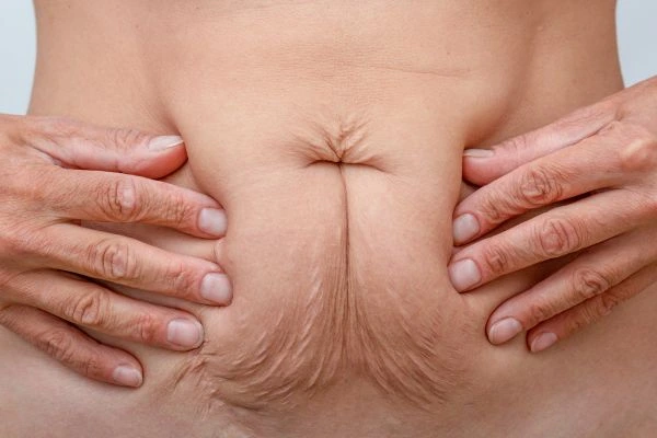 Image of a woman's stomach with loose skin - example of skin tightening Leicester options