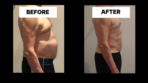 What Symptoms Can Diastasis Recti Cause in Men? Weak Core, Back Pain and Poor Posture Leicester